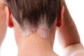 Psoriasis homeopathic treatments in karachi