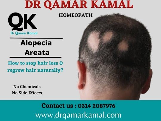 Alopecia areata treatment in karachi pakistan